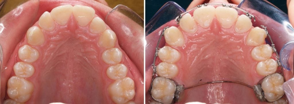 Palatal Expanders in Dallas-Fort Worth, TX